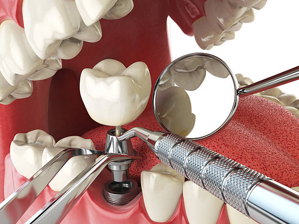 Best Urgent Care for Lost Fillings or Crowns in Richboro, PA